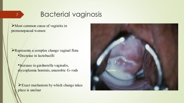 bacterium infection vaginal Bacterium infection vaginal